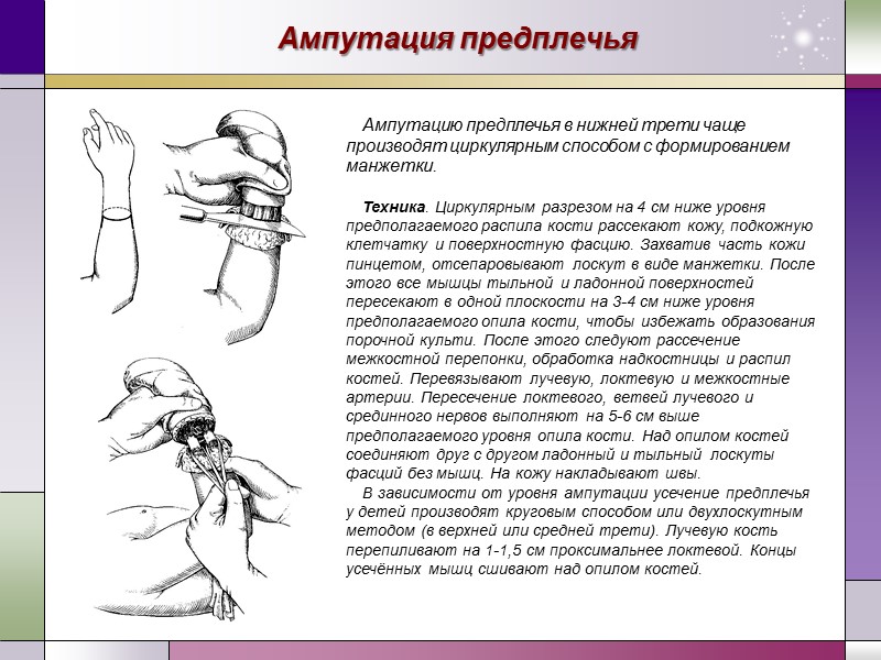 Ампутация предплечья Ампутацию предплечья в нижней трети чаще производят циркулярным способом с форми­рованием манжетки.